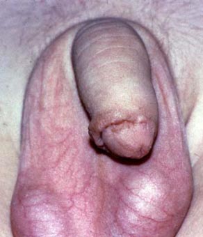 Adhesions to Head of Penis: - More Cutting Likely Needed