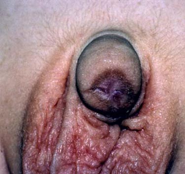 Post-circ phimosis - Head of penis covered more surgery likely