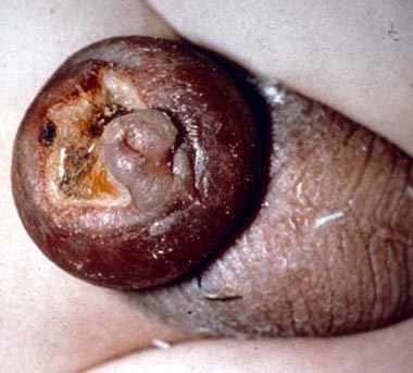 Partial glans amputation - Head of penis partially amputated